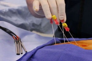 лечение гемангиомы печени