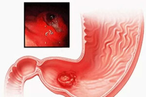 лейомиома желудка