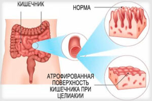 целиакия