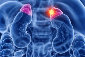 рак надпочечников