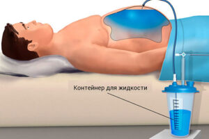 лечение асцита