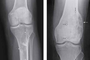 ретикулосаркома