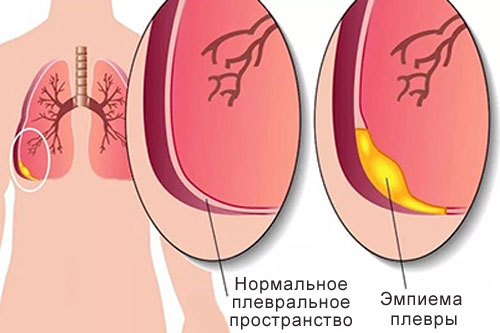 Плеврит — что это, причины, симптомы, диагностика | Блог | Complimed