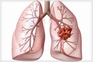 гамартома легкого