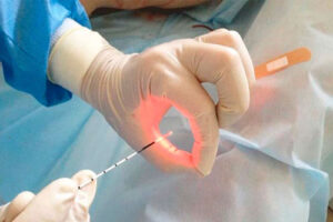 лечение гамартомы легкого