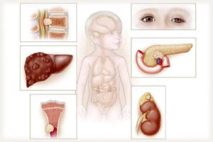 ганглионейробластома