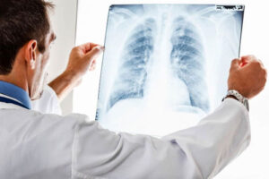 гемангиома легких