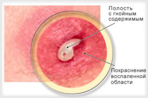 актиномикоз