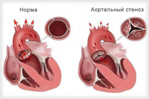 аортальный стеноз