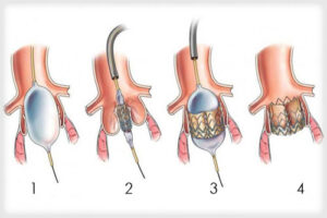 лечение аортального стеноза