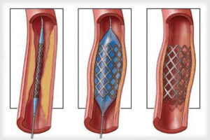 лечение атеросклероза