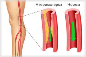 атеросклероз