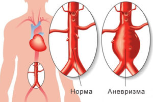 аневризма аорты