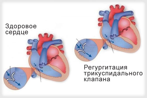 Ларингофарингеальный рефлюкс - причины, симптомы и лечение