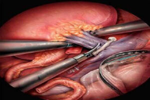 Нефрэктомия