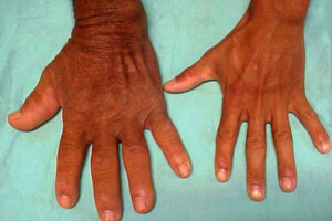 акромегалия