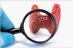  аутоиммунный тиреоидит