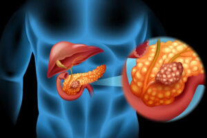 гастринома