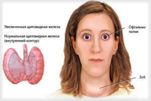 гипертиреоз