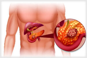 глюкагонома