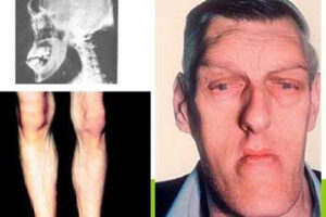 акромегалия