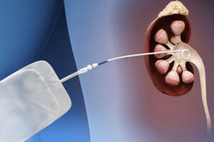 пионефроз лечение