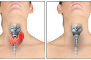 аутоиммунный тиреоидит лечение