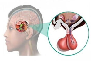 пролактинома