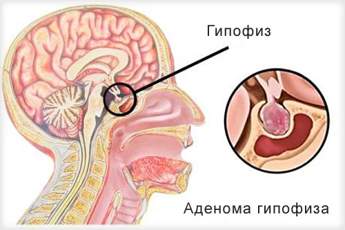 Лечение аденомы гипофиза в Испании