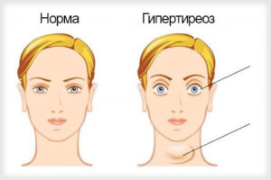 гипертиреоз
