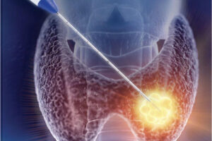 гипертиреоз лечение