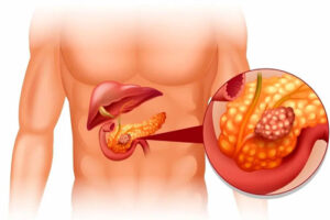 глюкагонома