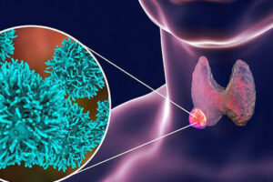 трабекулярная аденома