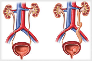 мегауретер