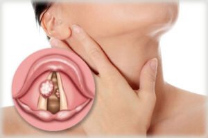 папилломатоз гортани