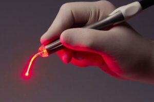 папилломатоз гортани лечение