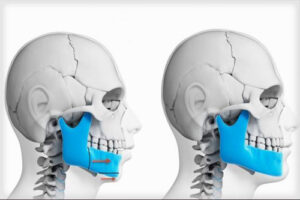 синдром Крузона