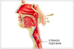 стеноз гортани