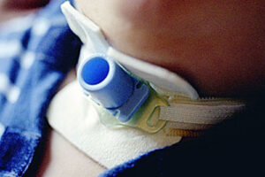 стеноз гортани лечение