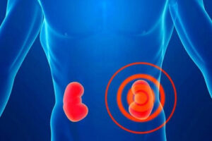 мегакаликоз