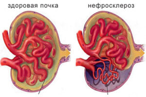 нефросклероз