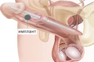 кавернит лечение