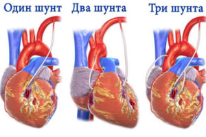 закупорка сосудов лечение