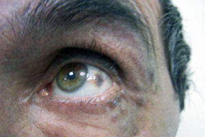 алкаптонурия