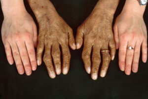 гемохроматоз