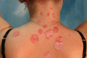 грибовидный микоз