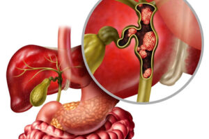 холангиокарцинома