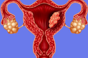 хориокарцинома