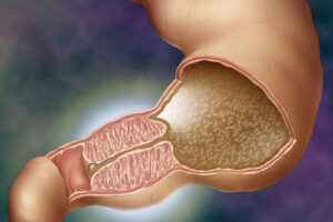 пилоростеноз