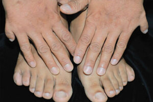 полидактилия